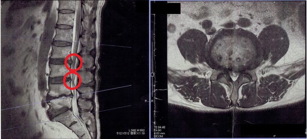 脊柱管狭窄症のMRI画像№2