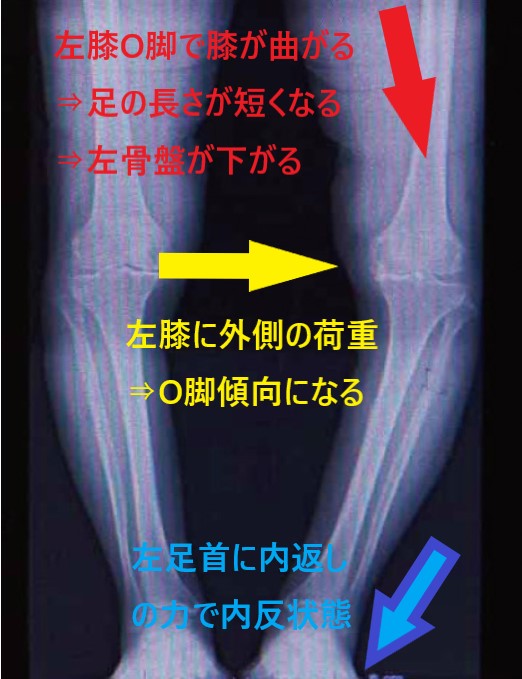 左足首の内返しの力で内反状態となり、左膝に外側の力が働くことでO脚を誘因し、左骨盤が下がっているレントゲン画像