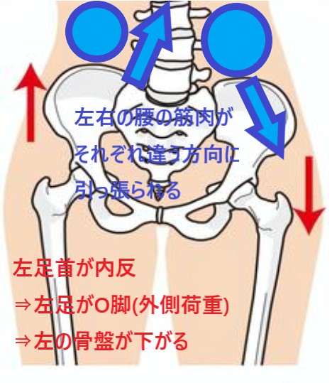 左足首が内反することで左足がO脚となり、左骨盤が下がることで左腰の筋肉は外下方へ下がり、右腰の筋肉は内上方へ引っ張られる