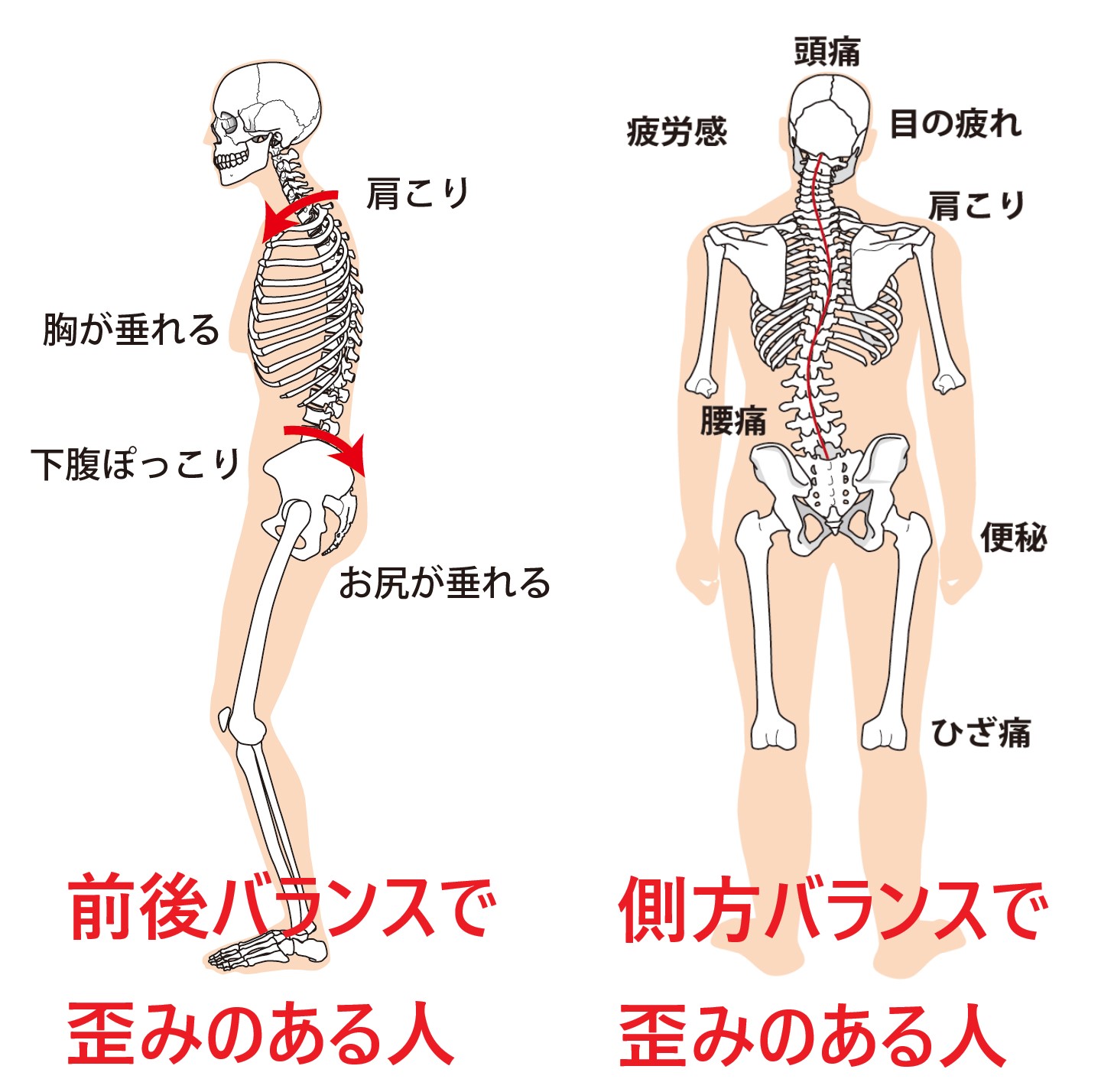 首肩の張り痛みが骨盤の歪みから起こり、全身バランスを悪くして症状が良くならない説明画像