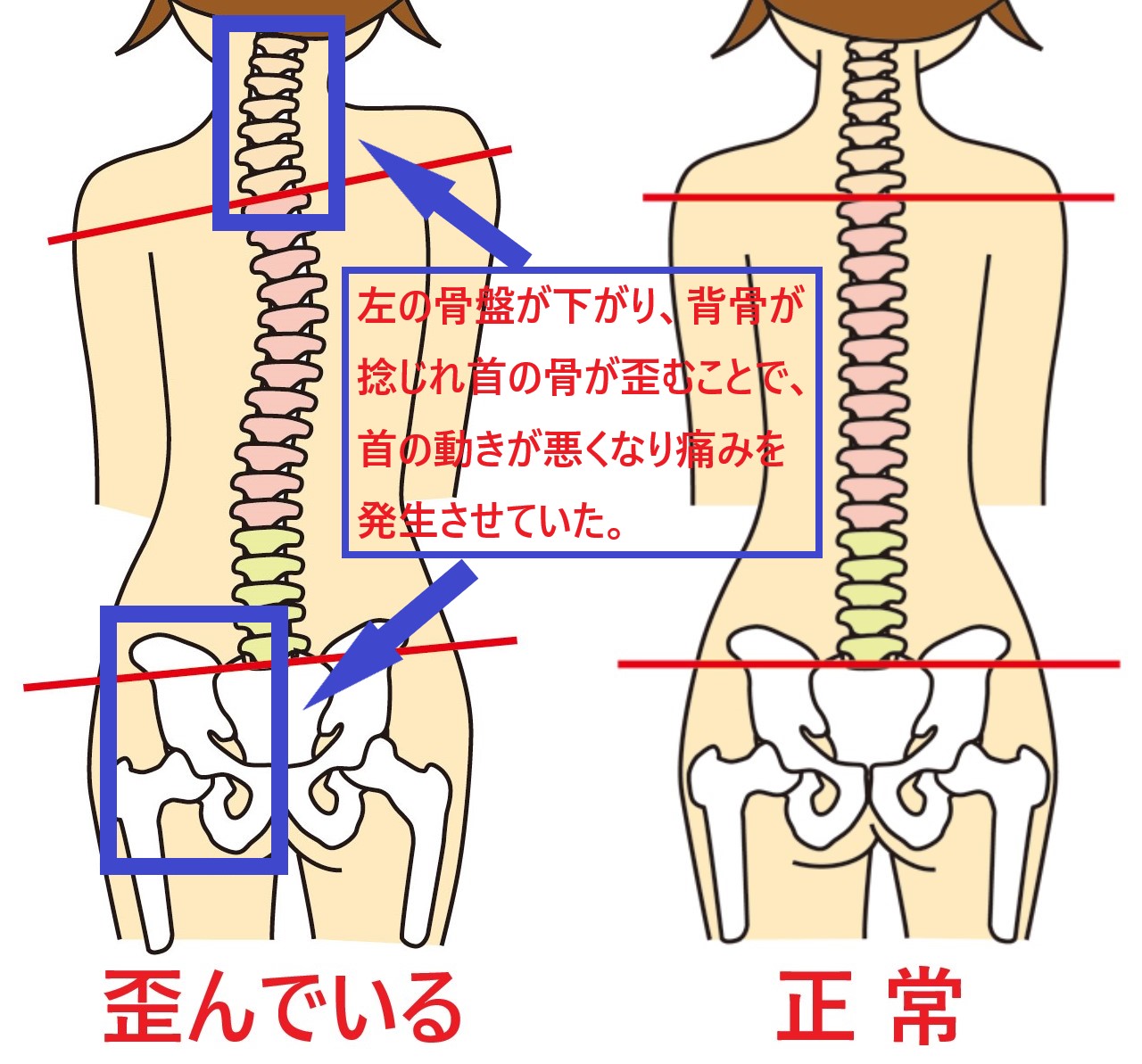 骨盤の歪みを戻すことで首の歪みを正しい位置に戻し、首の痛みを改善します