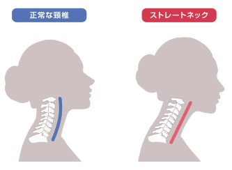 正常な首の骨の前湾と首の骨が真っ直ぐになって異常を起こしているストレートネックの首の状態の比較