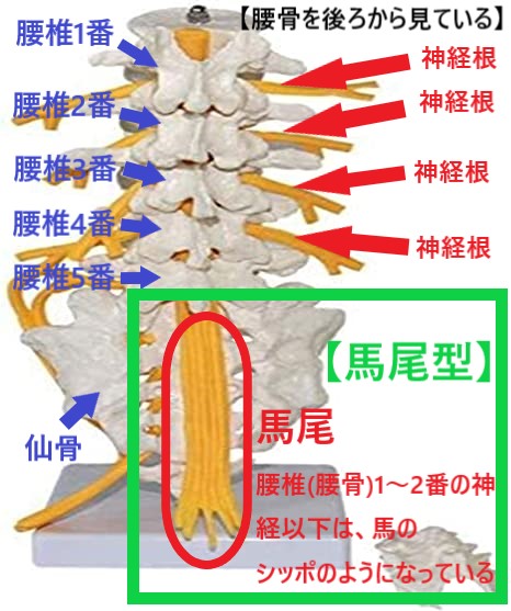 腰部脊柱管狭窄症の分類で馬尾型を表した図