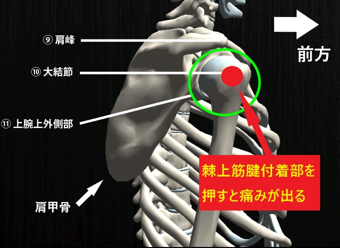 棘上筋腱付着部の大結節を示す図で、ここを押すと痛みが出る