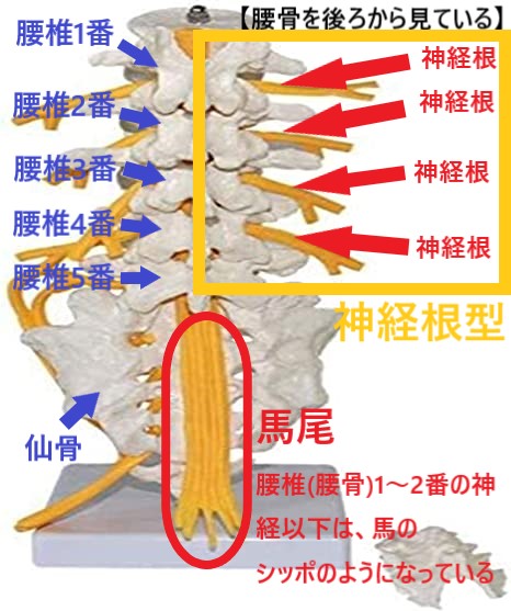 腰部脊柱管狭窄症の分類の神経根型をあらわしている図