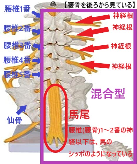 腰部脊柱管狭窄症の分類での混合型をあらわした図
