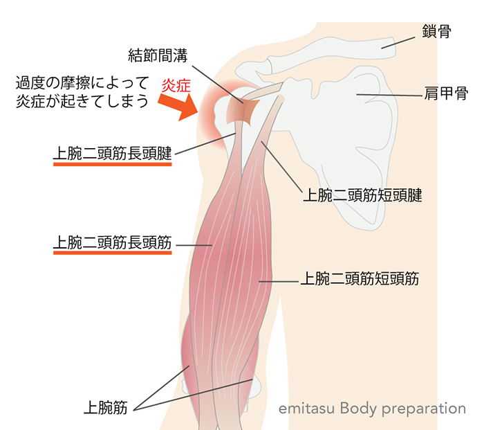 上腕二頭筋腱炎の起こるメカニズムの説明